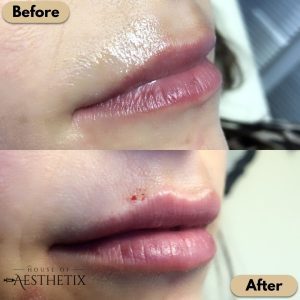 Lip Fillers Before and After images | House of Aesthetix | San Diego CA