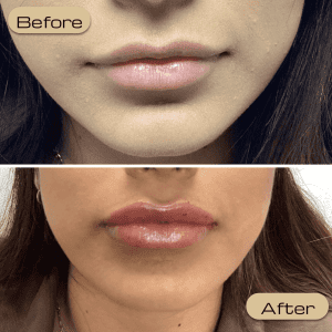 dermal filler San Diego