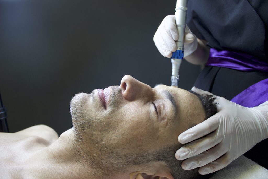 Microneedling Guide