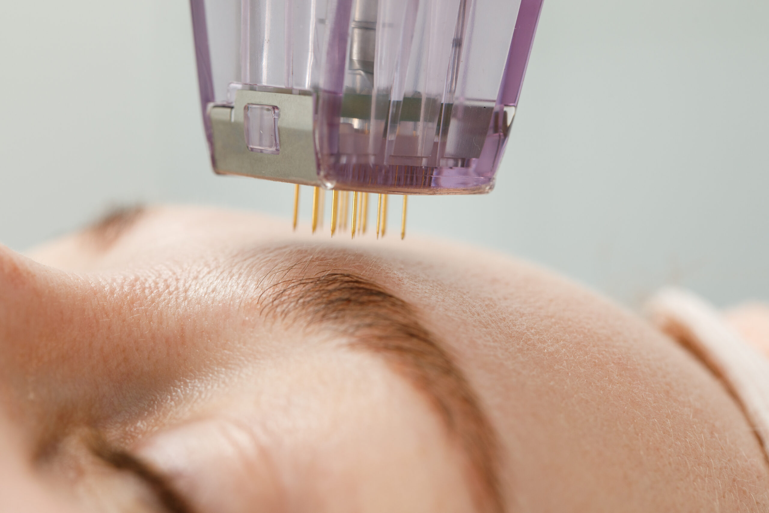 Professional Microneedling