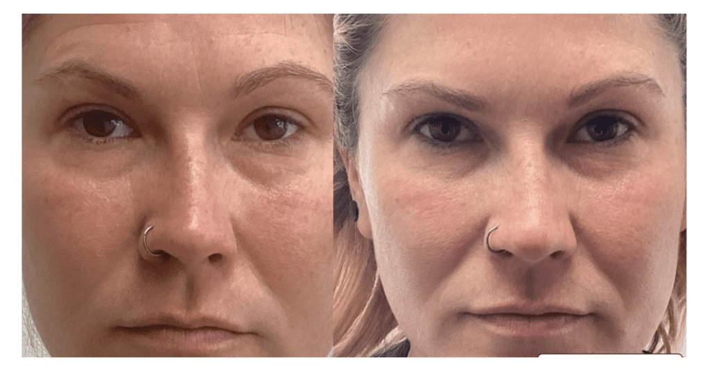 Botox treatment
