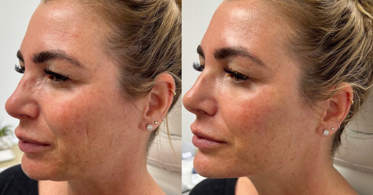 Kybella injectable treatment