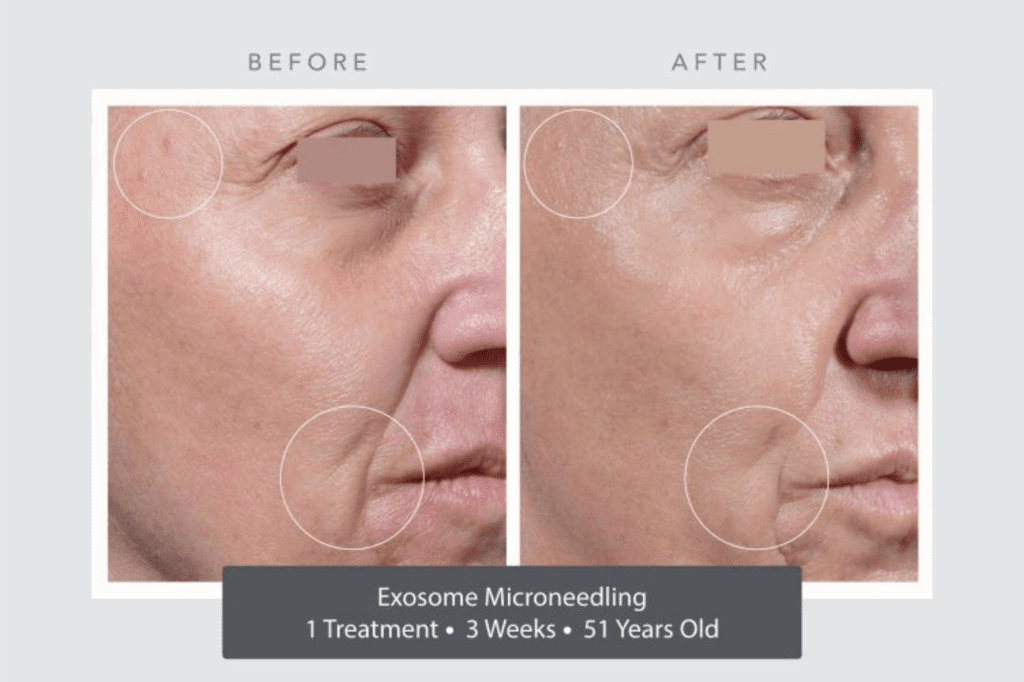 microneedling treatment