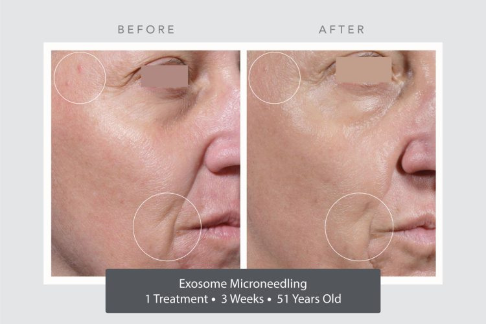 microneedling treatment