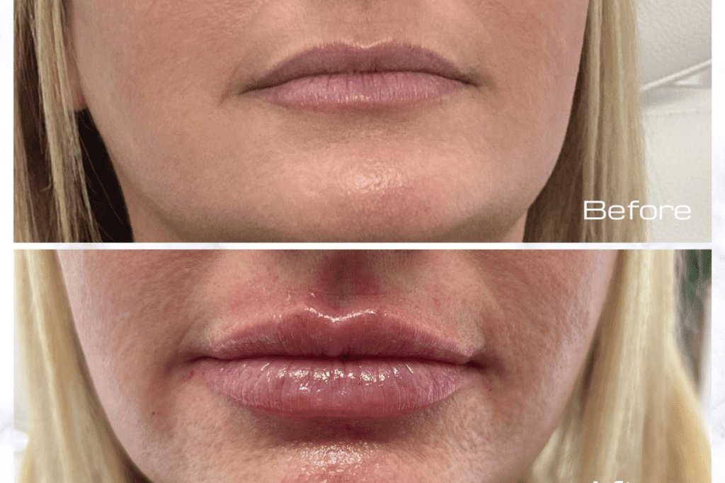 lip filler treatments